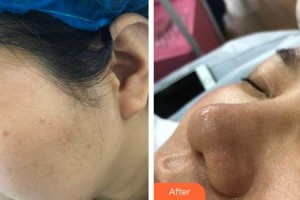 成都悅好醫(yī)學(xué)美容醫(yī)院王丹整形價(jià)格表附小蔡果酸案例展示