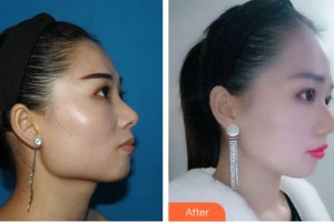 成都風(fēng)尚格致醫(yī)學(xué)美容整形醫(yī)院李繼華整形價(jià)格表附頜面整形案例展示