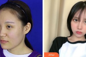 成都華顏醫(yī)療美容門診部王平整形價(jià)格表附鼻部手術(shù) 面部吸脂案例展示