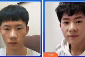 成都蜀尚蓉雅美容整形醫(yī)院常小莉整形價(jià)格表附雙眼皮案例展示