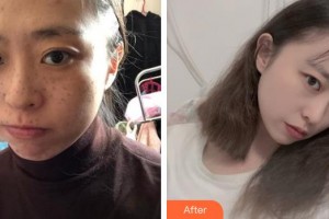 成都蜀尚蓉雅美容整形醫(yī)院陳秀榮整形價(jià)格表附鼻部手術(shù)案例展示