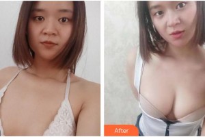 成都金榮醫(yī)學(xué)美容診所周金芳整形價(jià)格表附濃縮豐胸真實(shí)案例展示