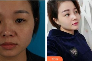 成都金榮醫(yī)學(xué)美容診所林登文整形價(jià)格表附隆鼻案例展示