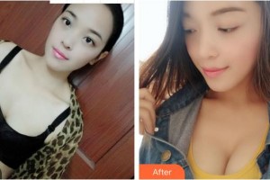 成都博雅整形門診部鄒盛勇整形價(jià)格表附隆胸案例展示