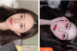 成都金榮醫(yī)學(xué)美容診所張高欣整形價(jià)格表附小氣泡案例展示