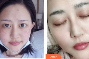 成都美瑞皮膚美容門診部鄭可揚(yáng)整形價(jià)格表附激光祛斑案例展示