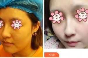 成都美瑞皮膚美容門診部高淑華整形價(jià)格表附激光祛斑案例展示