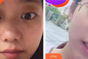 成都艾尚醫(yī)學(xué)美容門診部王琳整形價(jià)格表附祛斑案例展示