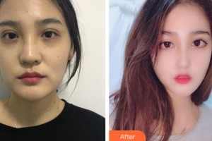 成都美瑞皮膚美容門診部邵勇整形價(jià)格表附隆鼻案例展示