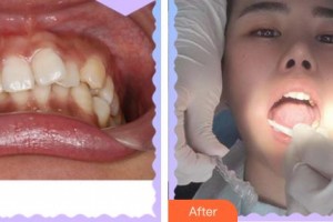 合肥劉大夫美容整形醫(yī)院羅永祥整形價(jià)格表附隱形托槽矯正案例展示