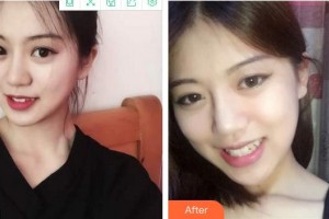 合肥劉大夫美容整形醫(yī)院呂希華整形價(jià)格表附面部吸脂案例展示