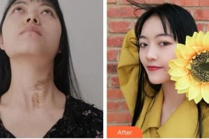 成都醫(yī)學(xué)院第一附屬醫(yī)院燒傷整形科馬兵整形價(jià)格表附祛疤案例展示