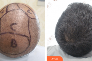 廣州新發(fā)現(xiàn)植發(fā)連鎖機構(gòu)伍喜進整形價格表附頭發(fā)種植案例展示