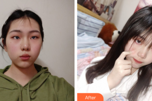 廣州膚美美容醫(yī)院云整形價格表附超激光美膚案例展示