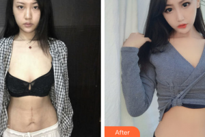 廣州紫馨美容醫(yī)院趙可整形價格表附激光祛疤案例展示