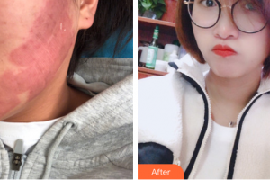 廣州紫馨美容醫(yī)院李豐霞整形價格表附點陣祛痘坑痘印案例展示