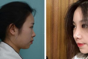 成都醫(yī)美整形美容醫(yī)院唐永實(shí)整形價(jià)格表附隆鼻案例展示