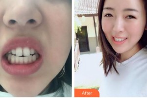 成都恒博醫(yī)院整形美容中心易湘豪整形價格表附隱形矯正案例展示