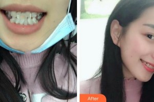 成都市第二人民醫(yī)院醫(yī)療美容科陳大夫整形價格表附半隱形牙齒矯正案例展示