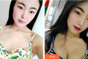 成都趙博士整形美容門診部趙善軍整形價格表附濃縮豐胸真實(shí)案例展示