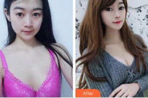 成都艾尚醫(yī)學(xué)美容門診部羅利達(dá)整形價格表附濃縮豐胸真實(shí)案例展示