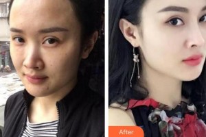 成都晶膚醫(yī)學(xué)美容醫(yī)院董薇薇整形價格表附抗皺案例展示