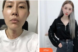 合肥劉大夫美容整形醫(yī)院徐娟整形價(jià)格表附祛疤案例展示