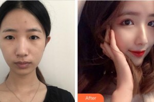 成都悅好醫(yī)學(xué)美容醫(yī)院李相穆整形價格表附眼部綜合案例展示