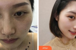 成都悅好醫(yī)學(xué)美容醫(yī)院楊艷整形價格表附激光美膚祛斑案例展示