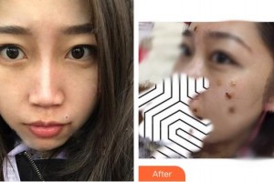 成都悅好醫(yī)學(xué)美容醫(yī)院陶曉蘋整形價格表附激光點(diǎn)痣案例展示