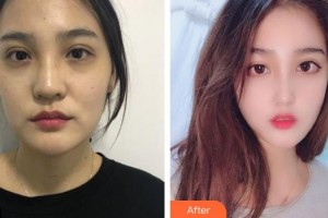 成都臺美仁仁醫(yī)學(xué)美容診所柯樹英整形價格表附鼻部手術(shù)案例案例展示