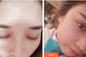 成都艾尚醫(yī)學(xué)美容門診部王超整形價格表附光子嫩膚案例展示