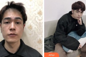 成都空軍醫(yī)院毛發(fā)移植中心劉珊珊整形價(jià)格表附發(fā)際線案例展示