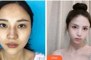 成都劉影美容整形門診部劉影整形價(jià)格表附眼瞼下至+面部吸脂+M唇案例展示