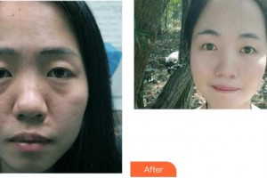 成都美瑞皮膚美容門診部董瀛整形價(jià)格表附光子嫩膚案例展示