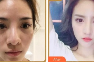 成都天使之翼醫(yī)學(xué)美容醫(yī)院李大光整形價(jià)格表附鼻部多項(xiàng)案例展示