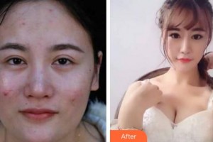 成都美瑞皮膚美容門診部馮慧潔整形價(jià)格表附光子嫩膚案例展示