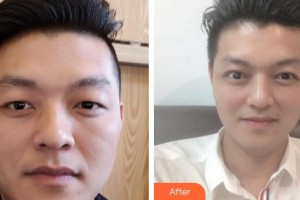 成都西區(qū)醫(yī)院醫(yī)學(xué)美容科孫文強(qiáng)整形價(jià)格表附切開雙眼皮案例展示