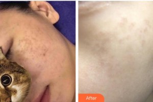 成都唯羅納醫(yī)療美容門診部廖美蓉整形價(jià)格表附蜂巢激光美膚激光祛斑案例展示