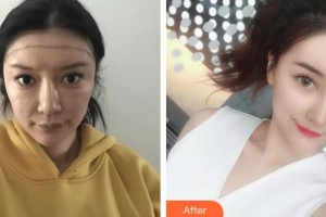 成都玉之光整形醫(yī)院劉中國整形價(jià)格表附發(fā)際線種植案例展示