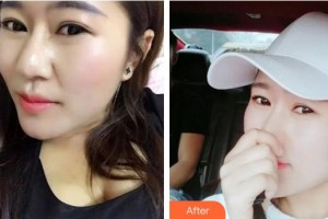 成都米蘭柏羽醫(yī)學(xué)美容醫(yī)院林楷貽整形價(jià)格表附果酸煥膚案例展示