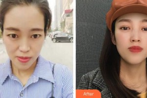 成都可思美醫(yī)學(xué)美容門診部潘紅偉整形價(jià)格表附眼部整形案例展示