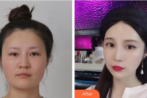 成都恒博醫(yī)院整形美容中心尹秉河整形價格表附頜面整形案例展示