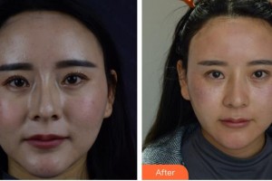 成都華顏醫(yī)療美容門診部楊燕整形價格表附皮膚管理-美白嫩膚-微針美膚案例展示