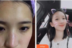 成都華顏醫(yī)療美容門診部張嶸整形價格表附祛斑案例展示