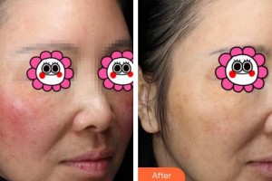 成都悅好醫(yī)學美容醫(yī)院楊翠霞整形價格表附祛紅血絲案例展示