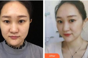 成都華倫鉑尚醫(yī)療美容診所蔣林君整形價格表附祛痘案例展示