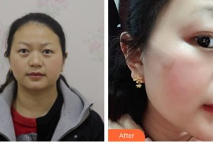 成都華康醫(yī)院美容整形外科劉可新整形價格表附面部疤痕修復案例展示