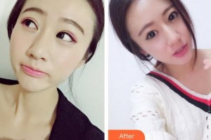 成都恩喜醫(yī)學整形美容醫(yī)院徐踴整形價格表附光子嫩膚案例展示