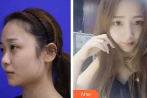 成都天之美醫(yī)療美容診所劉寧整形價格表附鼻部綜合案例展示